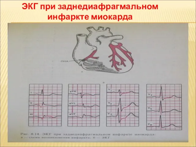 ЭКГ при заднедиафрагмальном инфаркте миокарда