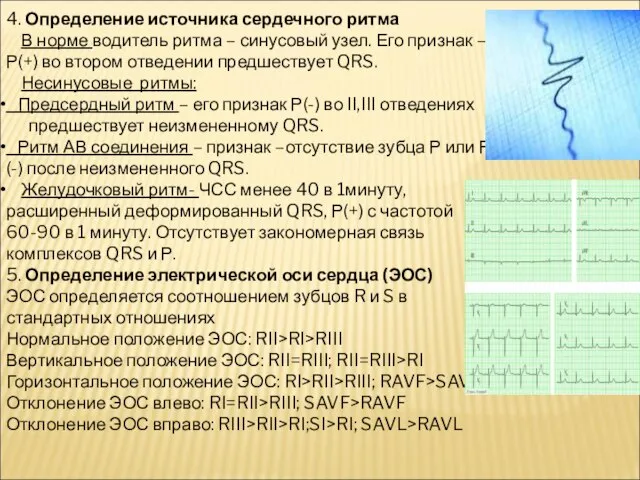 4. Определение источника сердечного ритма В норме водитель ритма – синусовый