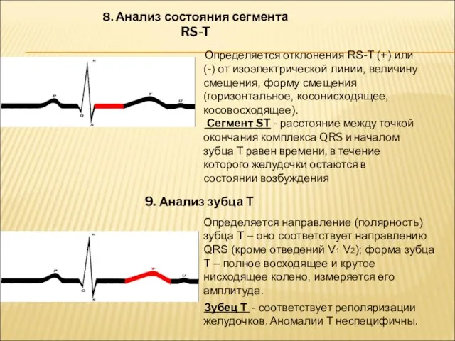 8. Анализ состояния сегмента RS-T Определяется отклонения RS-T (+) или (-)