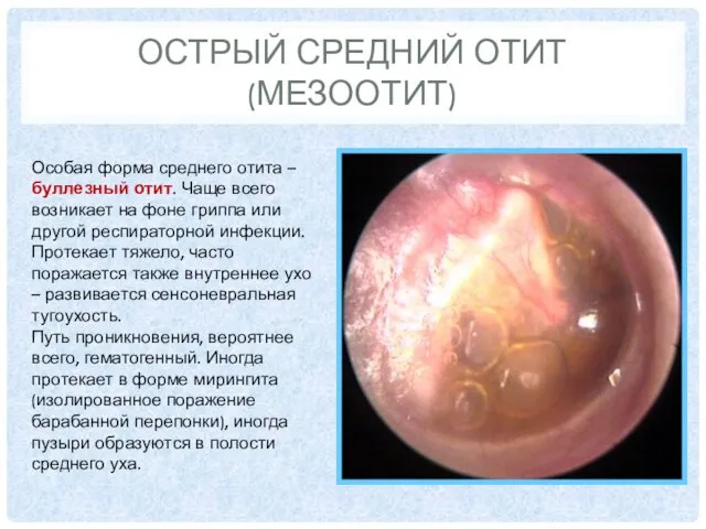 ОСТРЫЙ СРЕДНИЙ ОТИТ (МЕЗООТИТ) Особая форма среднего отита – буллезный отит.