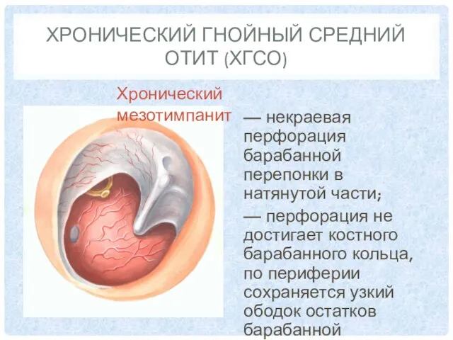 ХРОНИЧЕСКИЙ ГНОЙНЫЙ СРЕДНИЙ ОТИТ (ХГСО) — некраевая перфорация барабанной перепонки в