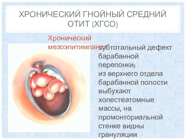 ХРОНИЧЕСКИЙ ГНОЙНЫЙ СРЕДНИЙ ОТИТ (ХГСО) субтотальный дефект барабанной перепонки; из верхнего