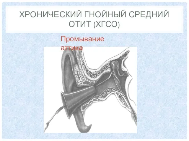 ХРОНИЧЕСКИЙ ГНОЙНЫЙ СРЕДНИЙ ОТИТ (ХГСО) Промывание аттика