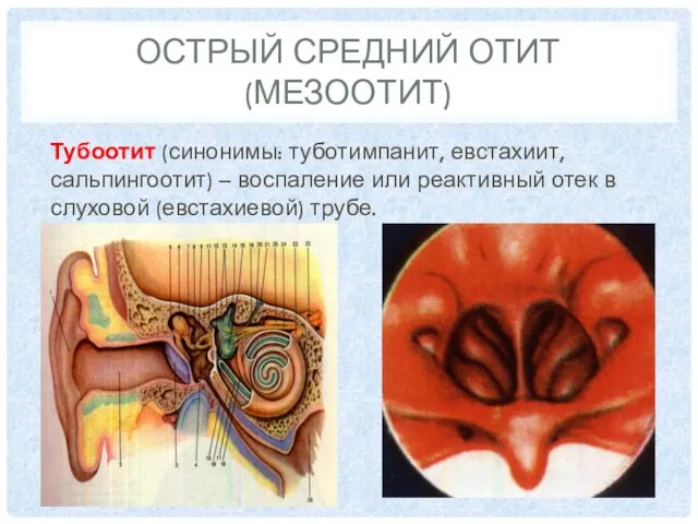 ОСТРЫЙ СРЕДНИЙ ОТИТ (МЕЗООТИТ) Тубоотит (синонимы: туботимпанит, евстахиит, сальпингоотит) – воспаление