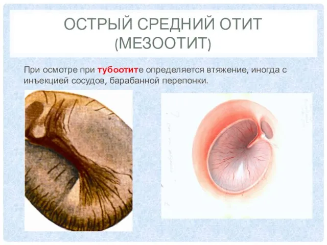 ОСТРЫЙ СРЕДНИЙ ОТИТ (МЕЗООТИТ) При осмотре при тубоотите определяется втяжение, иногда с инъекцией сосудов, барабанной перепонки.