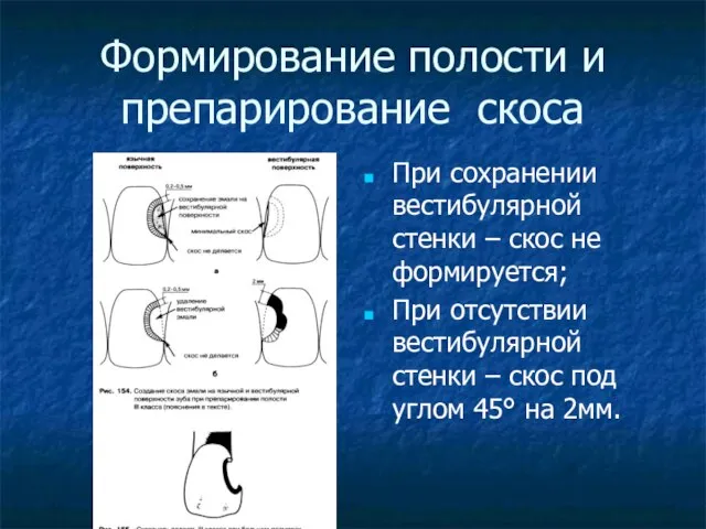 Формирование полости и препарирование скоса При сохранении вестибулярной стенки – скос