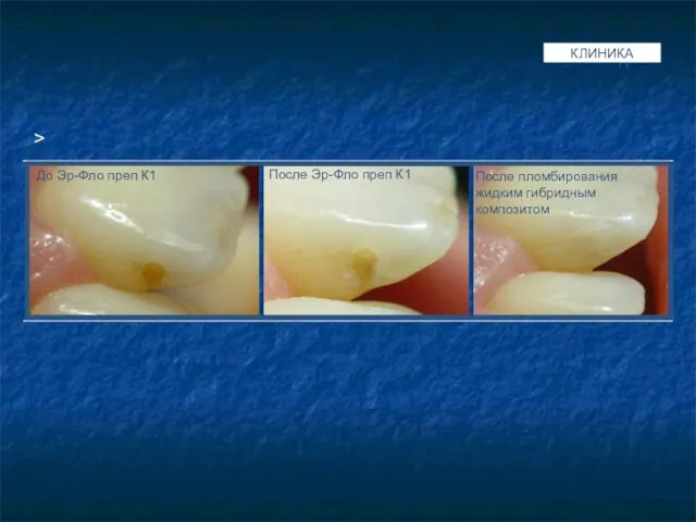 QUANTITY КЛИНИКА > До Эр-Фло преп К1 После Эр-Фло преп К1 После пломбирования жидким гибридным композитом