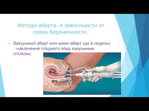 Методы аборта, в зависимости от срока беременности. Вакуумный аборт или мини-аборт