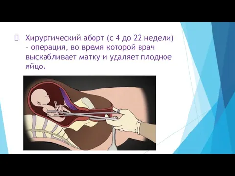 Хирургический аборт (с 4 до 22 недели) – операция, во время