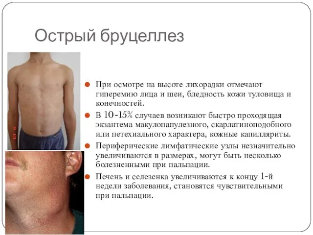 Острый бруцеллез При осмотре на высоте лихорадки отмечают гиперемию лица и