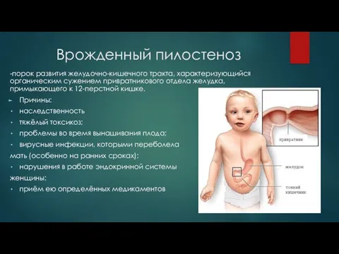 Врожденный пилостеноз -порок развития желудочно-кишечного тракта, характеризующийся органическим сужением привратникового отдела