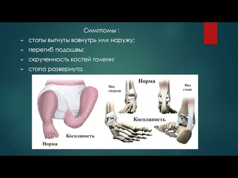 Симптомы : стопы выгнуты вовнутрь или наружу; перегиб подошвы; скрученность костей голени; стопа развернута.