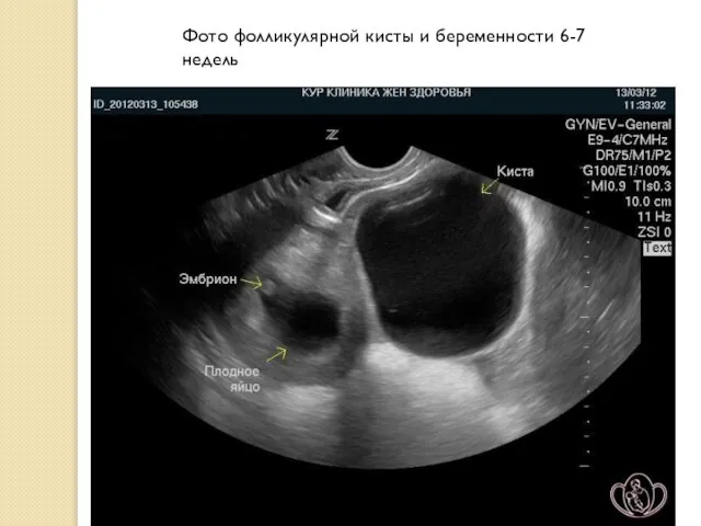 Фото фолликулярной кисты и беременности 6-7 недель