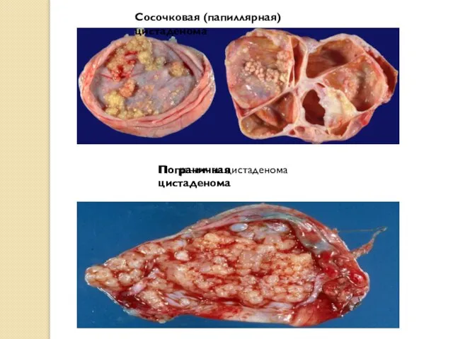 Сосочковая (папиллярная) цистаденома Пограничная цистаденома Пограничная цистаденома Пограничная цистаденома