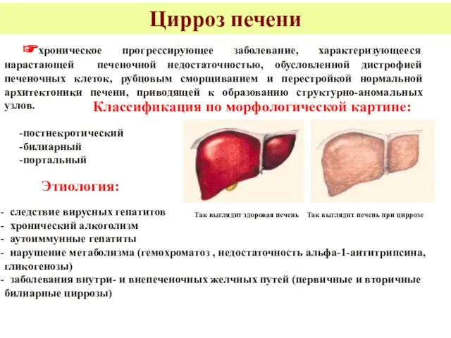 Цирроз печени ☞хроническое прогрессирующее заболевание, характеризующееся нарастающей печеночной недостаточностью, обусловленной дистрофией