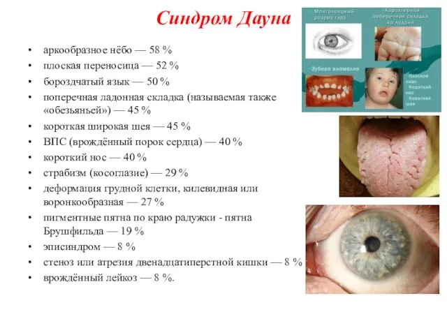 Синдром Дауна аркообразное нёбо — 58 % плоская переносица — 52