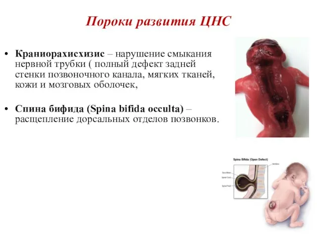 Пороки развития ЦНС Краниорахисхизис – нарушение смыкания нервной трубки ( полный