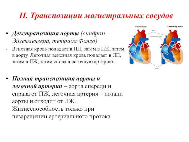 II. Транспозиции магистральных сосудов Декстрапозиция аорты (синдром Эйзенменгера, тетрада Фалло) Венозная