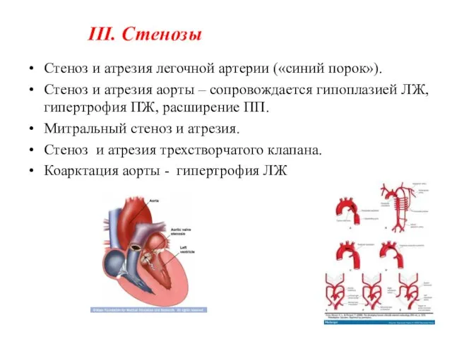 III. Стенозы Стеноз и атрезия легочной артерии («синий порок»). Стеноз и