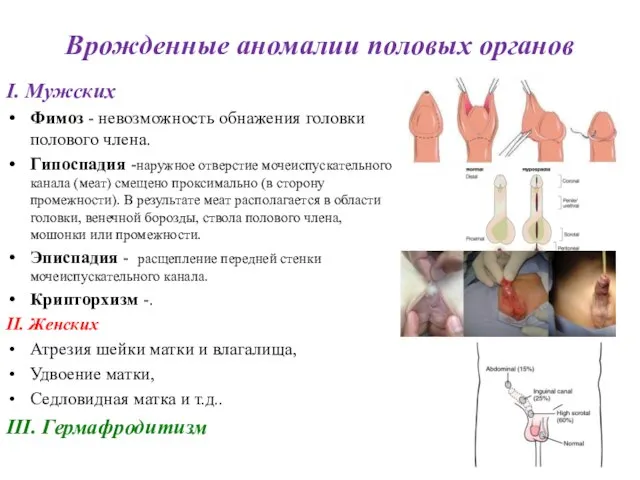 Врожденные аномалии половых органов I. Мужских Фимоз - невозможность обнажения головки