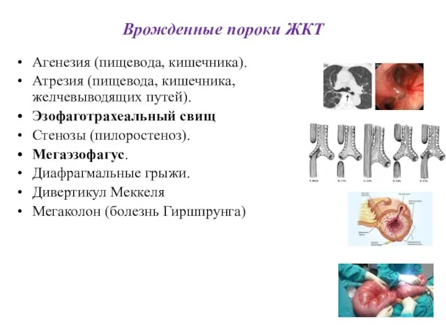 Врожденные пороки ЖКТ Агенезия (пищевода, кишечника). Атрезия (пищевода, кишечника, желчевыводящих путей).