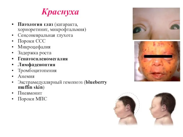 Краснуха Патология глаз (катаракта, хориоретинит, микрофтальмия) Сенсоневральная глухота Пороки ССС Микроцефалия