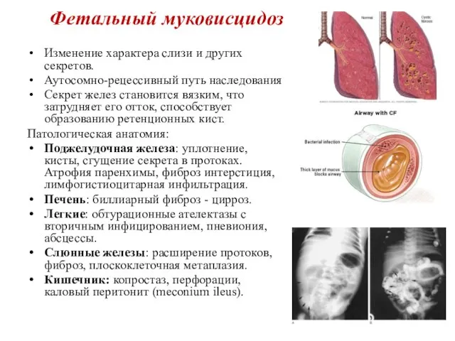 Фетальный муковисцидоз Изменение характера слизи и других секретов. Аутосомно-рецессивный путь наследования