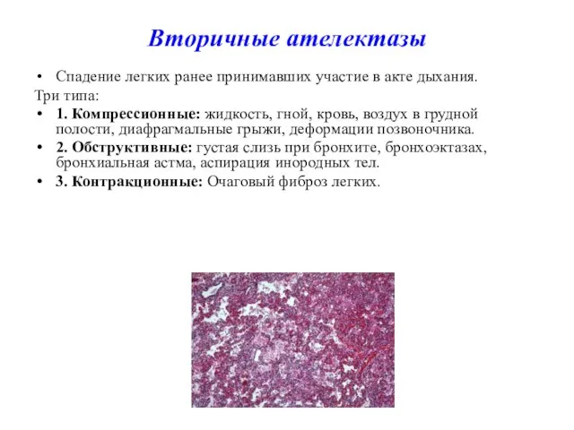 Вторичные ателектазы Спадение легких ранее принимавших участие в акте дыхания. Три