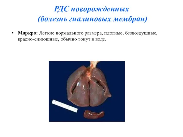 РДС новорожденных (болезнь гиалиновых мембран) Маркро: Легкие нормального размера, плотные, безвоздушные, красно-синюшные, обычно тонут в воде.