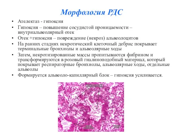 Морфология РДС Ателектаз - гипоксия Гипоксия – повышение сосудистой проницаемости –