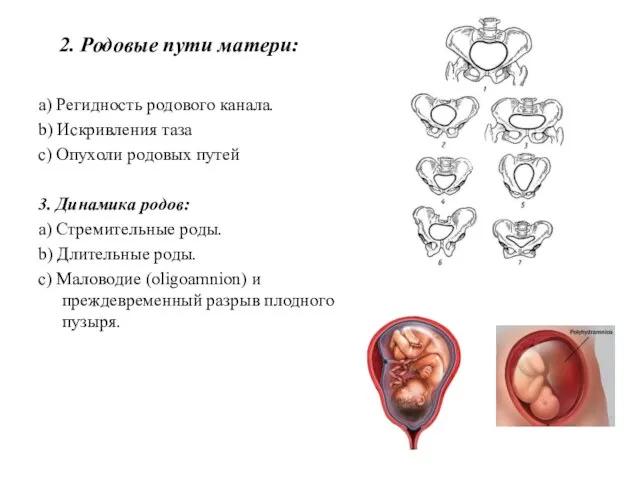 2. Родовые пути матери: a) Регидность родового канала. b) Искривления таза