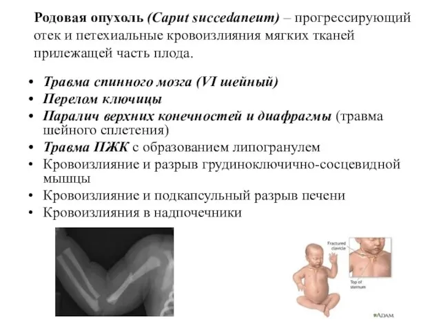 Родовая опухоль (Caput succedaneum) – прогрессирующий отек и петехиальные кровоизлияния мягких