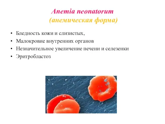 Anemia neonatorum (анемическая форма) Бледность кожи и слизистых, Малокровие внутренних органов