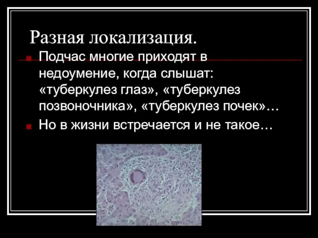 Разная локализация. Подчас многие приходят в недоумение, когда слышат: «туберкулез глаз»,