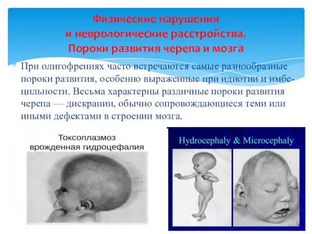 При олигофрениях часто встречаются самые разнообразные пороки развития, особенно выраженные при