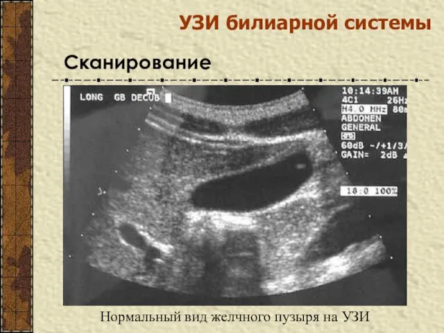 УЗИ билиарной системы Сканирование Нормальный вид желчного пузыря на УЗИ