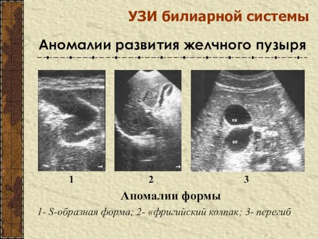 УЗИ билиарной системы Аномалии развития желчного пузыря 1 2 3 Аномалии