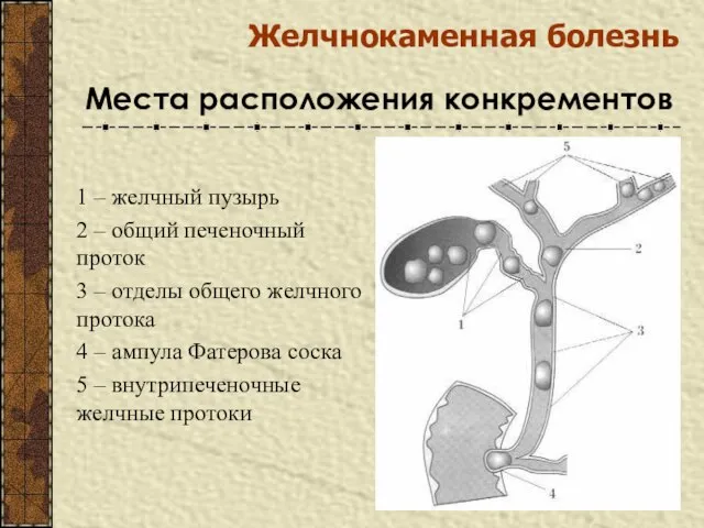 Желчнокаменная болезнь Места расположения конкрементов 1 – желчный пузырь 2 –