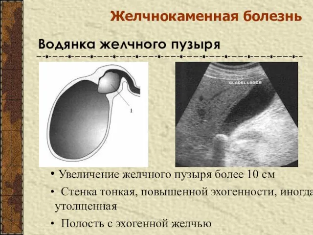 Желчнокаменная болезнь Водянка желчного пузыря Увеличение желчного пузыря более 10 см