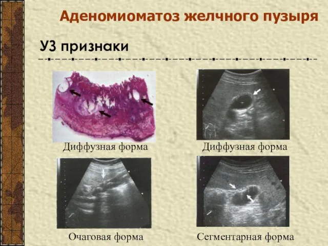 Аденомиоматоз желчного пузыря Сегментарная форма Диффузная форма Диффузная форма Очаговая форма УЗ признаки