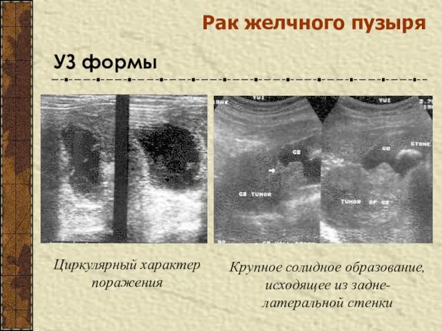 УЗ формы Рак желчного пузыря Циркулярный характер поражения Крупное солидное образование, исходящее из задне-латеральной стенки