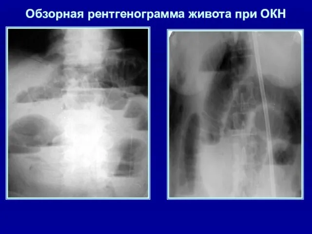 Обзорная рентгенограмма живота при ОКН