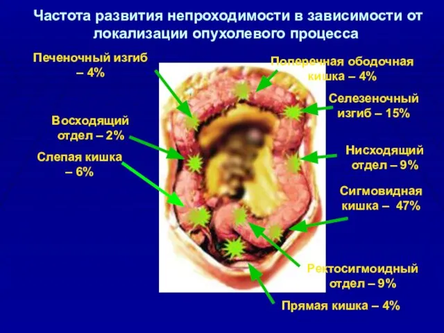 Частота развития непроходимости в зависимости от локализации опухолевого процесса Прямая кишка