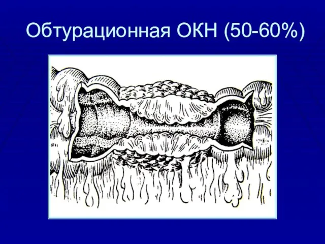 Обтурационная ОКН (50-60%)