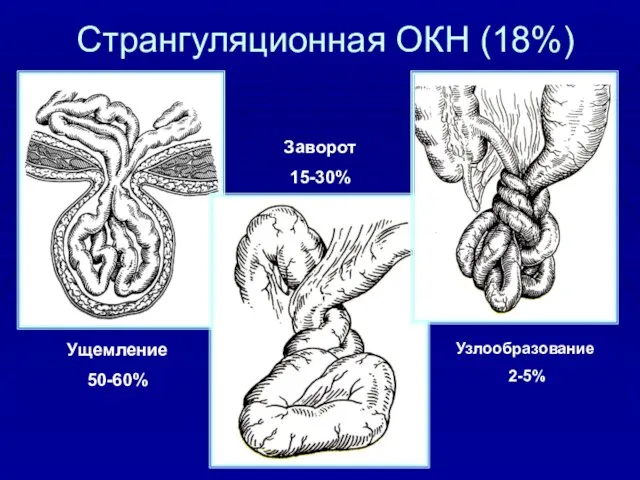 Странгуляционная ОКН (18%) Ущемление 50-60% Узлообразование 2-5% Заворот 15-30%