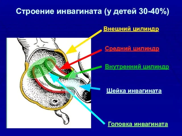 Строение инвагината (у детей 30-40%) Внешний цилиндр Средний цилиндр Внутренний цилиндр Шейка инвагината Головка инвагината