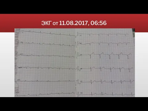 ЭКГ от 11.08.2017, 06:56