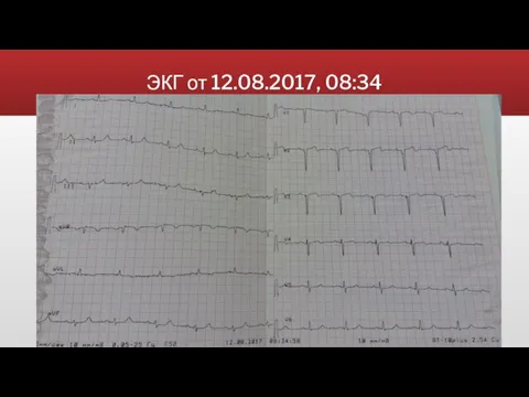 ЭКГ от 12.08.2017, 08:34