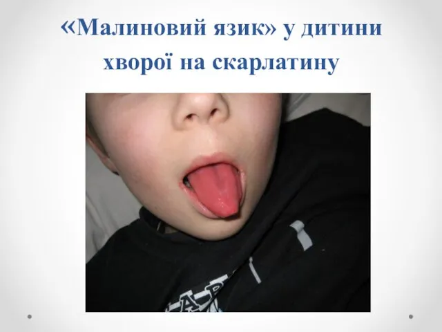 «Малиновий язик» у дитини хворої на скарлатину