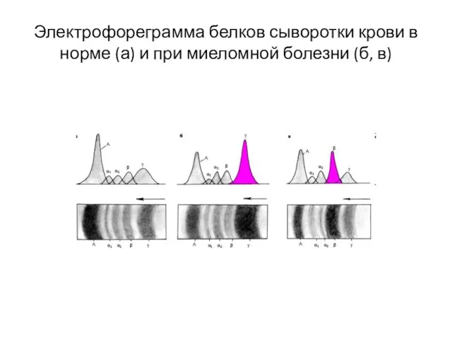 Электрофореграмма белков сыворотки крови в норме (а) и при миеломной болезни (б, в)